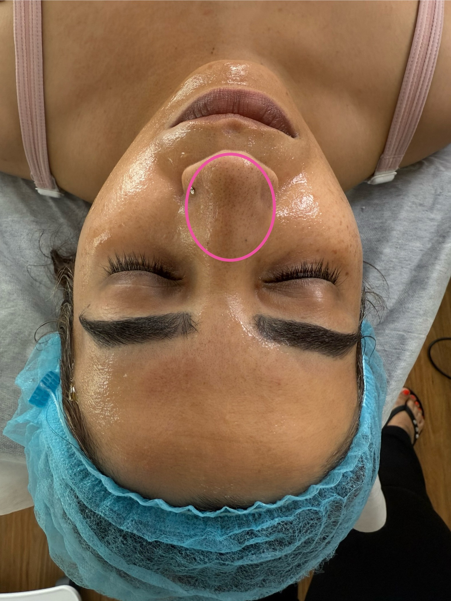 Client-supplied before photo showing blackhead congestion around the nose, marked with a pink circle